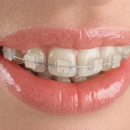 Clear Braces