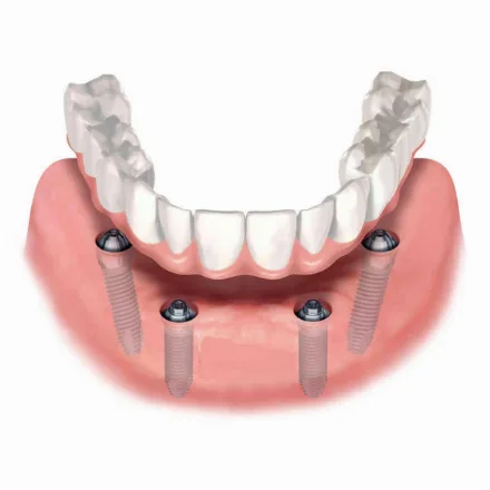 All on 4 dental implants