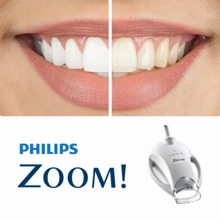 Sbiancamento dei denti Zoom