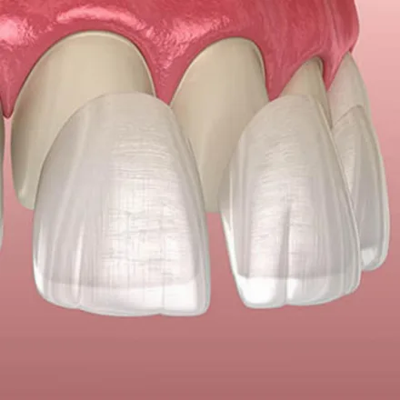 Faccette dentali ceramica