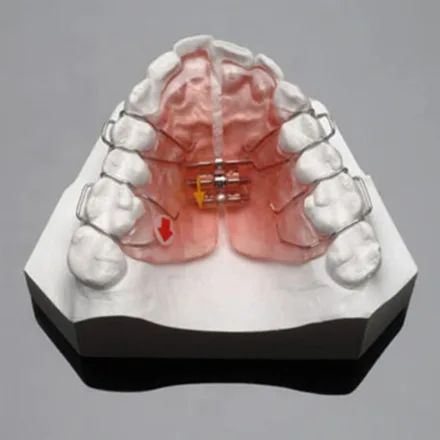 Removable orthodontic appliances