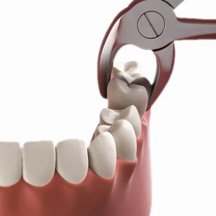 Estrazione chirurgica del dente