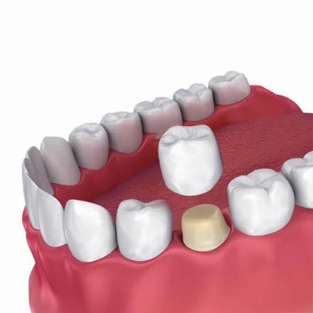 Zirconia crown