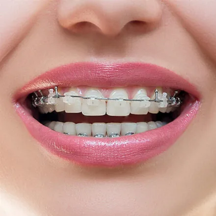Damon clear braces