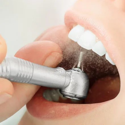 Sabbiatura dei denti con metodo air flow (rimozione della pigmentazione)