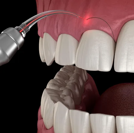 Gingivectomy