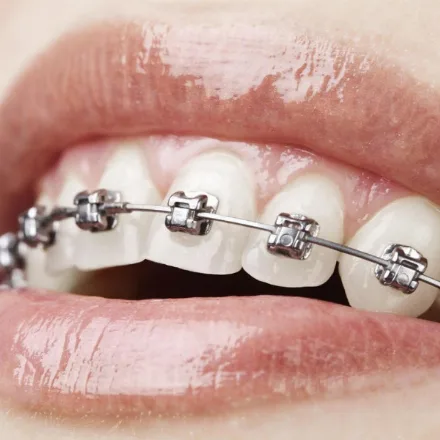 Fixed braces