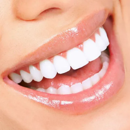 Hollywood smile