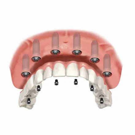 All on 6 dental implants (porcelain teeth)